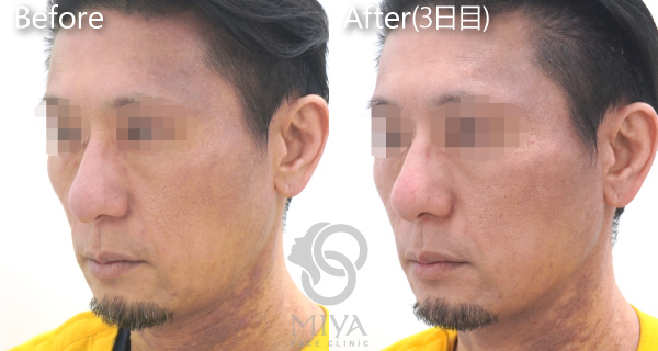 スレッドリフト アプトス 症例