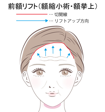前額リフトの施術説明図