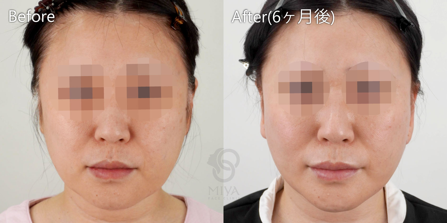 フェイスリフト症例