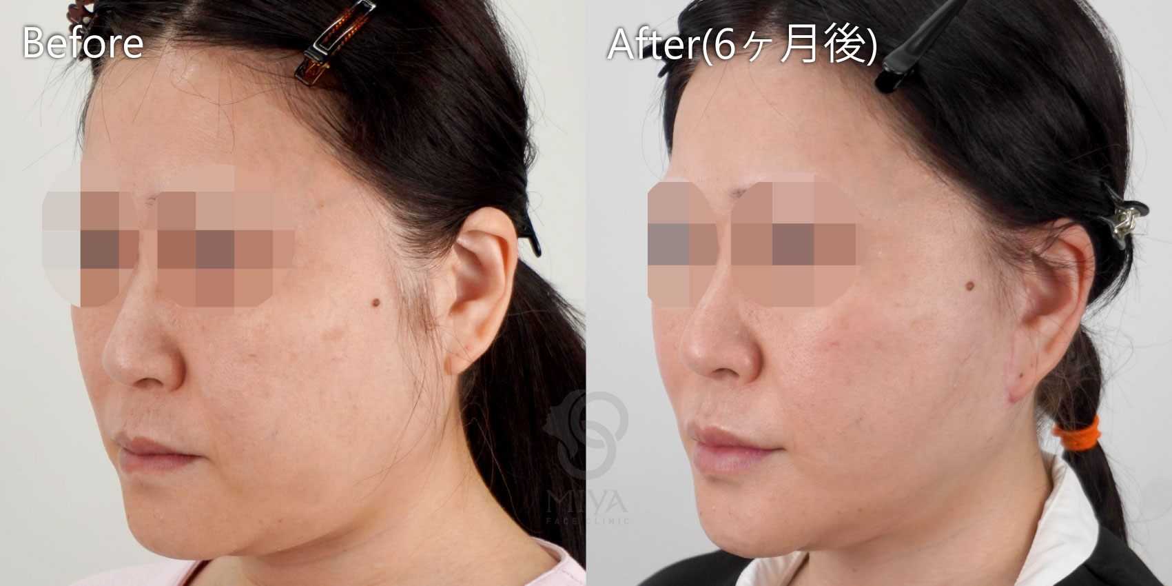 フェイスリフト症例