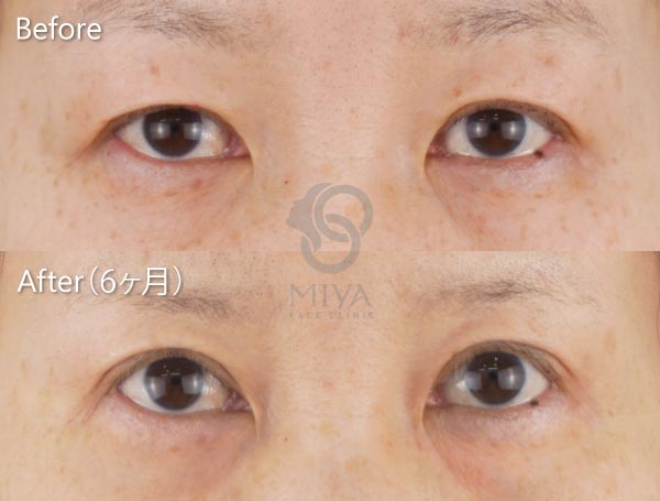 見開き拡大(眼瞼下垂) 症例