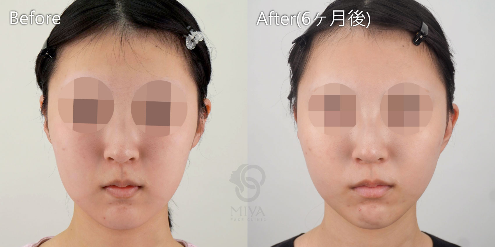 フェイスリフト症例