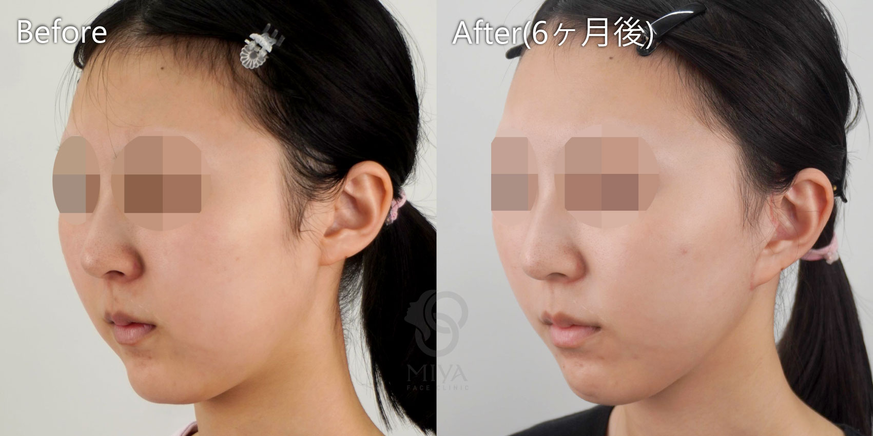 フェイスリフト症例