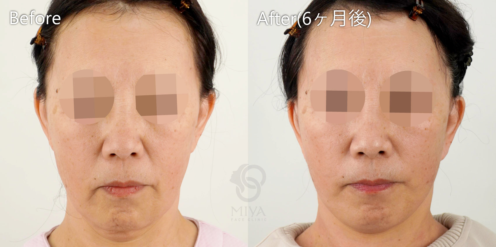 フェイスリフト症例