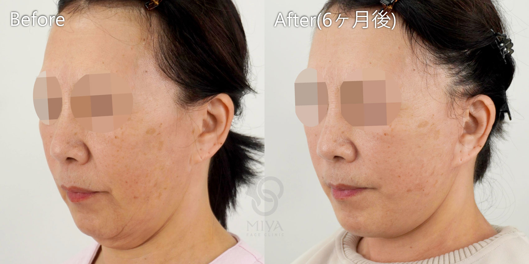 フェイスリフト症例