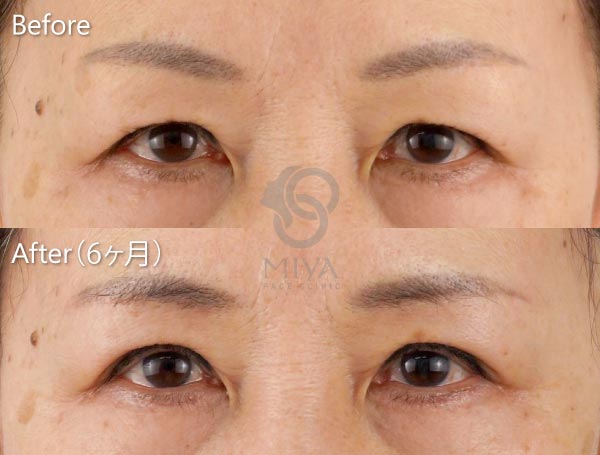 眉下切開術 症例