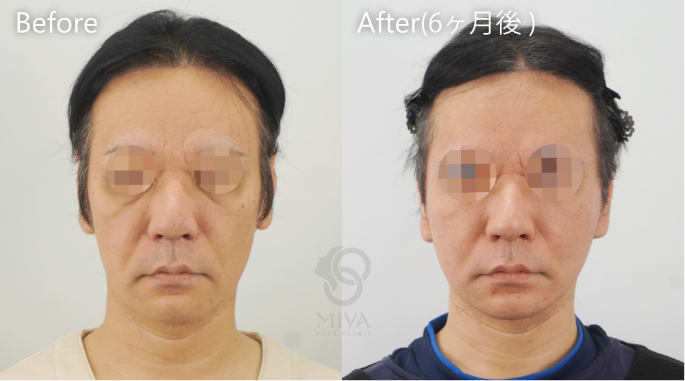 フェイスリフト症例