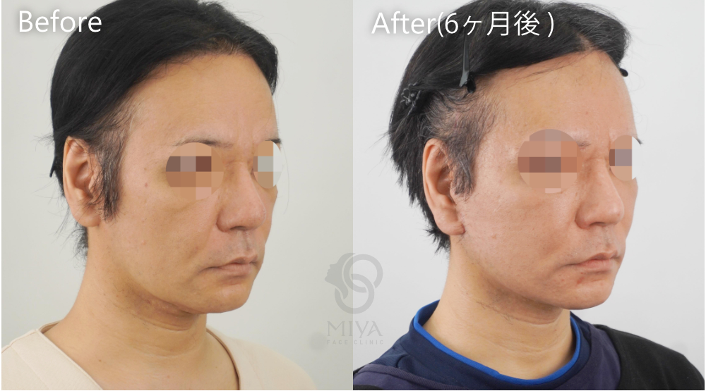 フェイスリフト症例